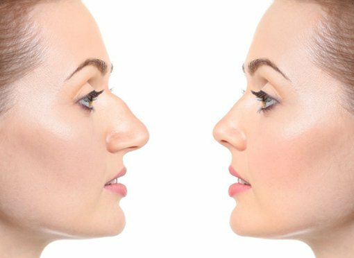 Considering Getting Rhinoplasty? Here's Your Boca Raton Guide