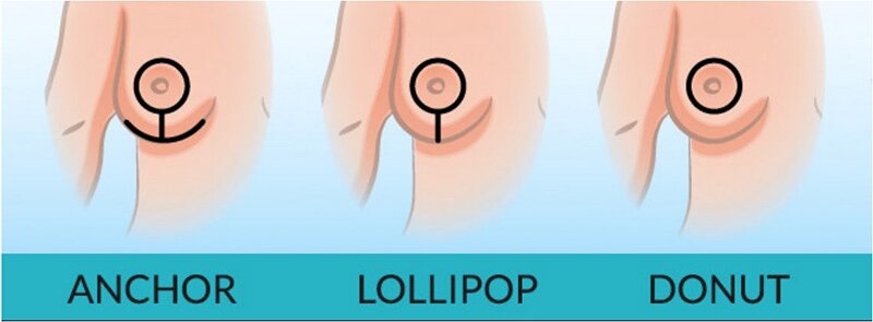 Breast Reduction Surgery Feature Image