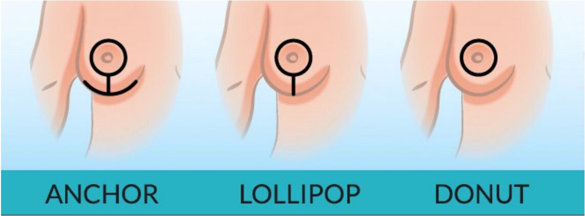Boca Raton Breast Lift With Implant Incisions
