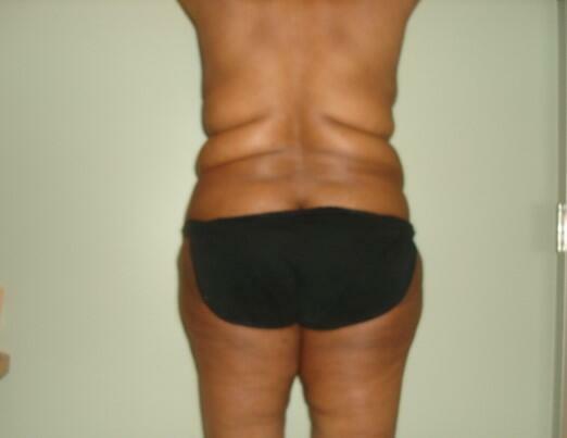 Back Fold Excision Before & After