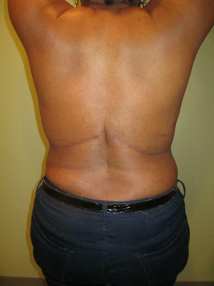 Back Fold Excision Before & After