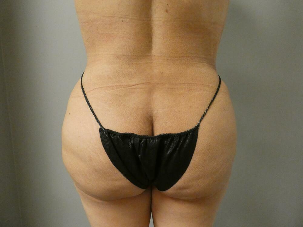 Brazilian Butt Lift Before & After