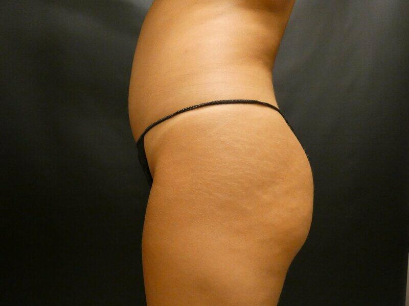 Brazilian Butt Lift Before & After