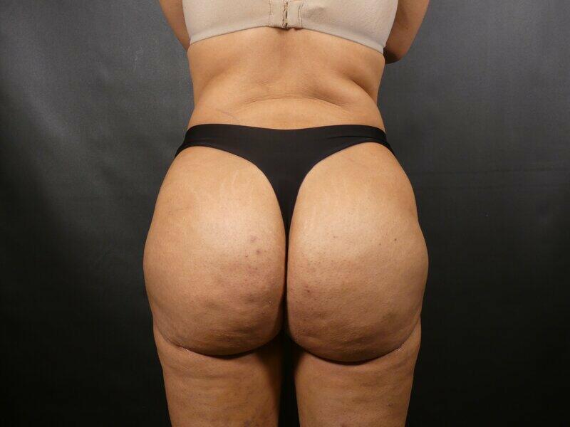 Brazilian Butt Lift Before & After