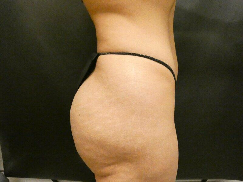 Brazilian Butt Lift Before & After