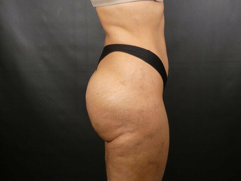 Brazilian Butt Lift Before & After