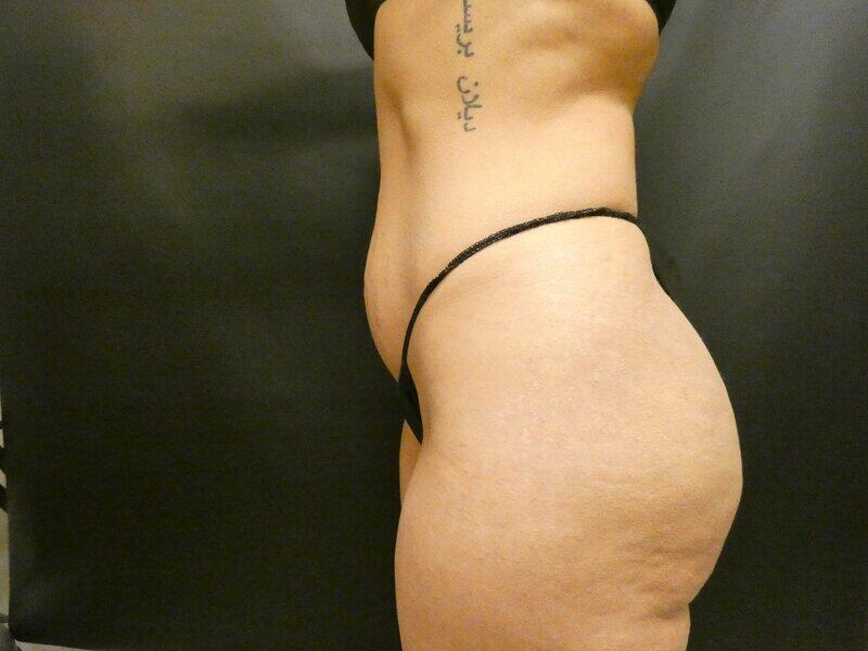 Brazilian Butt Lift Before & After