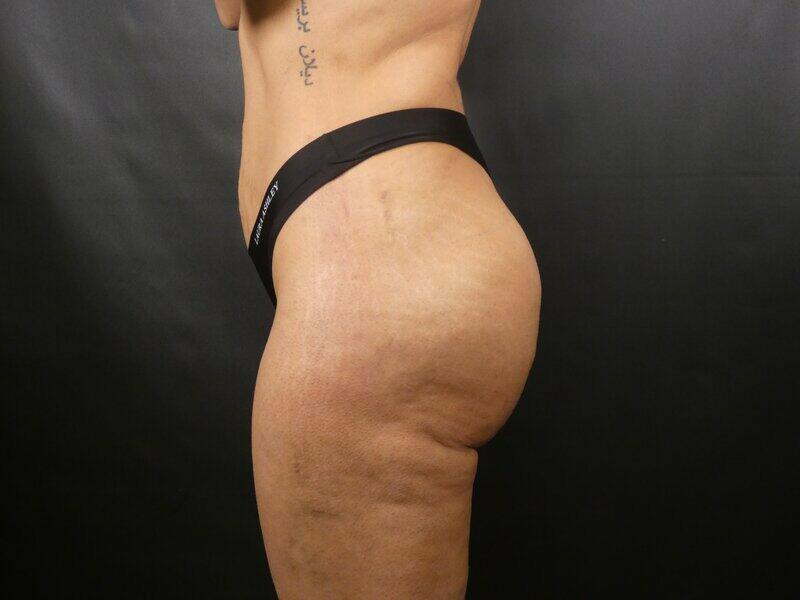 Brazilian Butt Lift Before & After