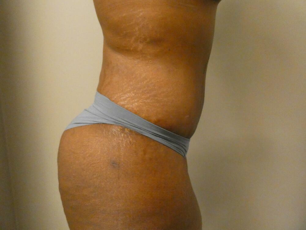 Liposuction Before & After