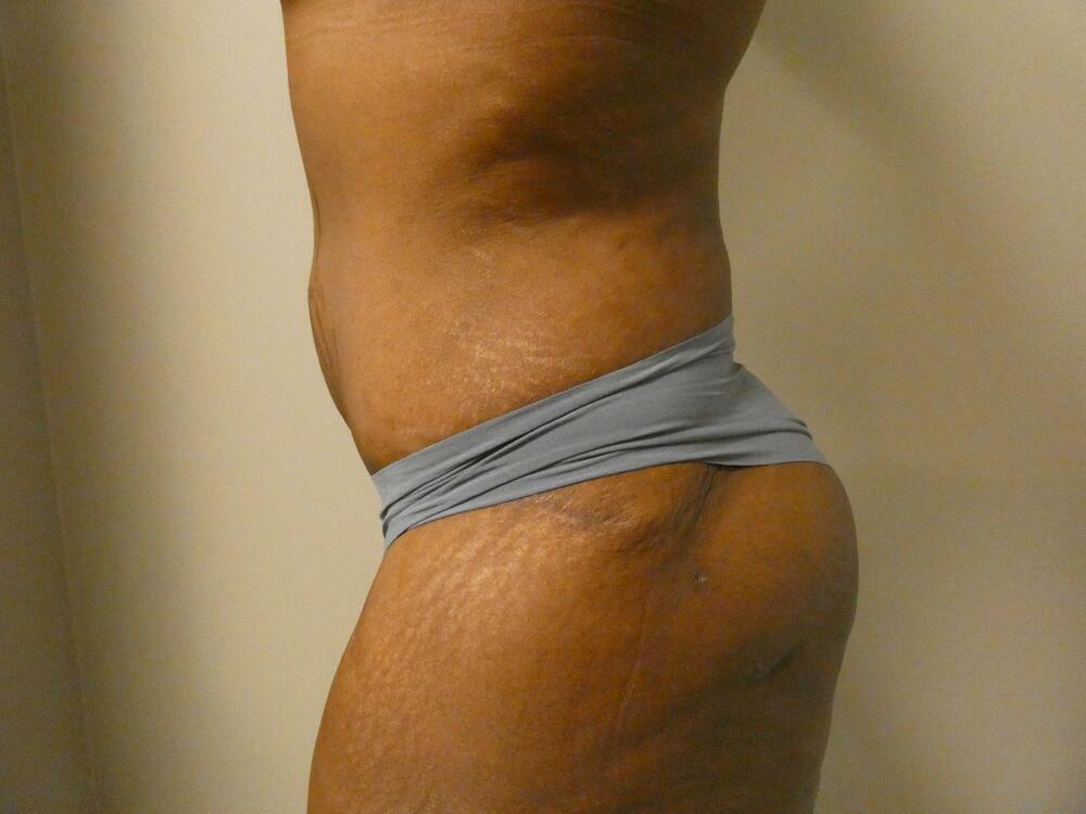 Liposuction Before & After