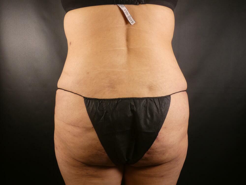 Liposuction Before & After