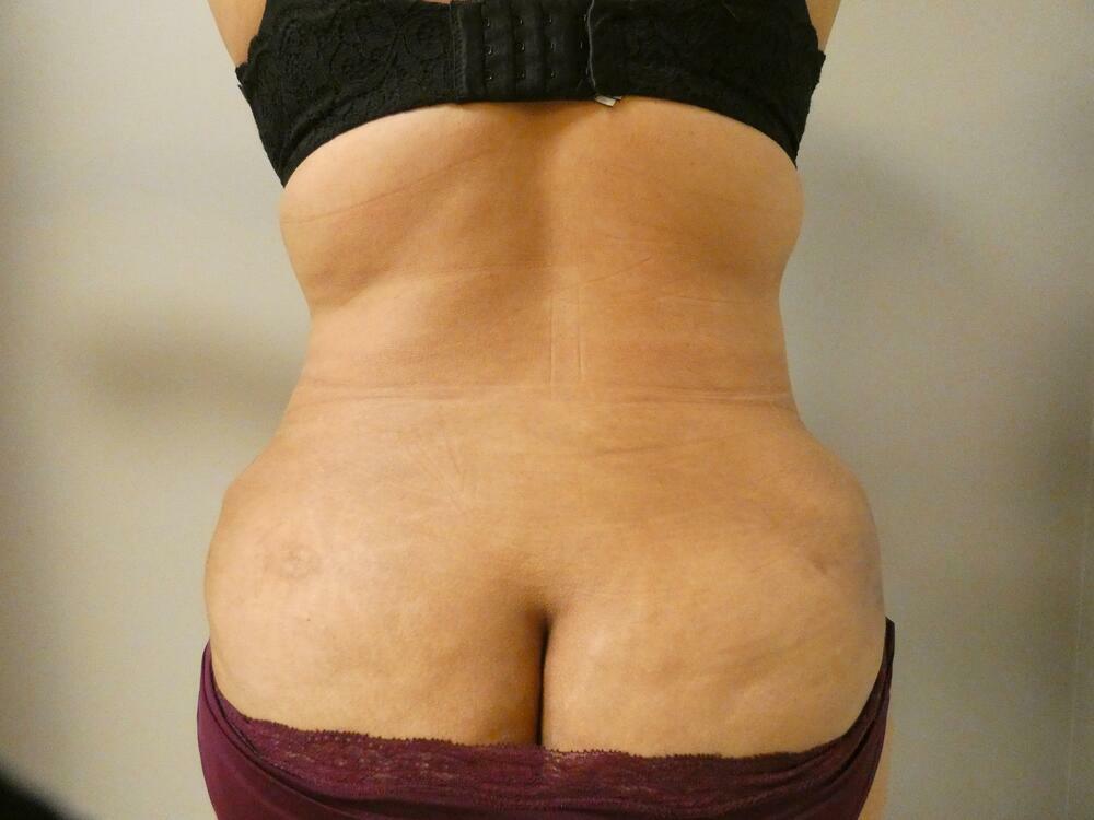 Liposuction Before & After