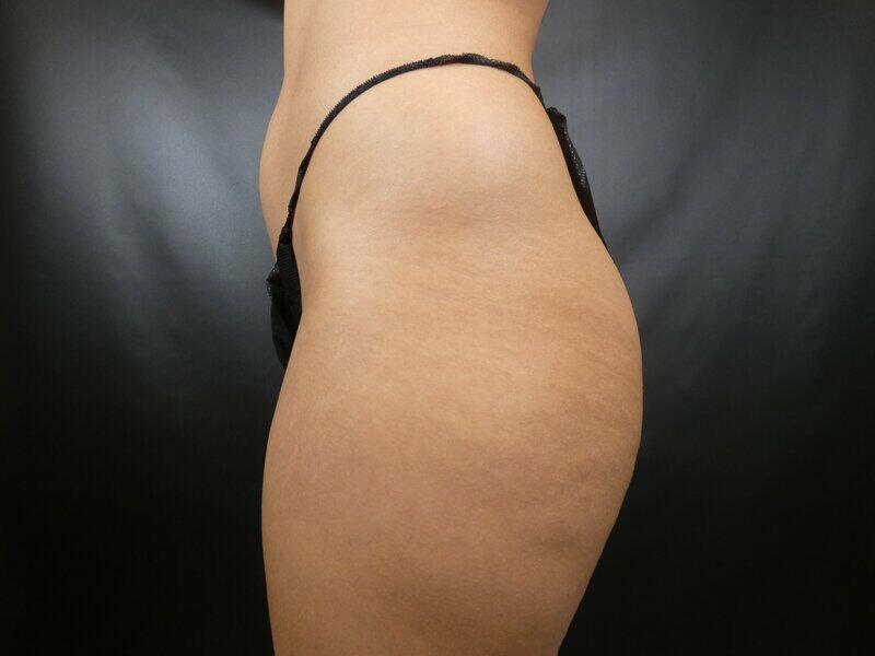 Liposuction Before & After