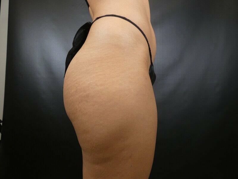 Liposuction Before & After