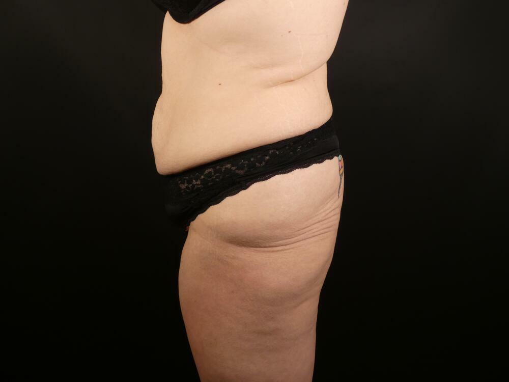 Tummy Tuck Before & After