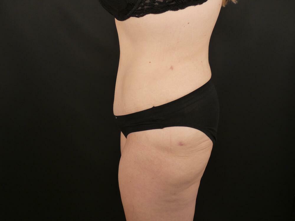 Tummy Tuck Before & After