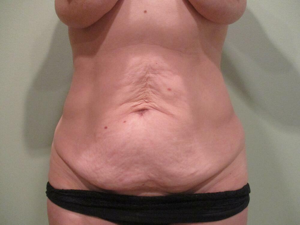 Tummy Tuck Before & After