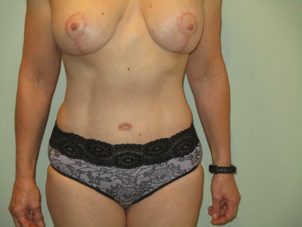 Tummy Tuck Before & After