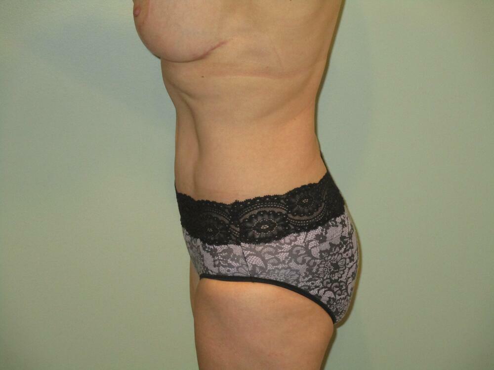 Tummy Tuck Before & After