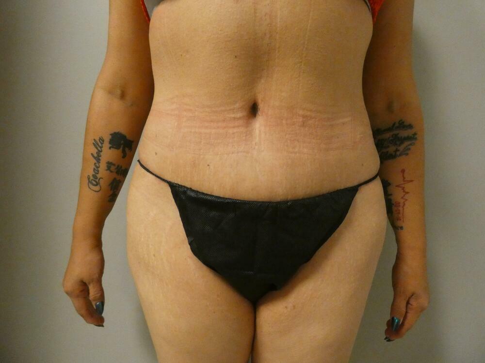 Tummy Tuck Before & After