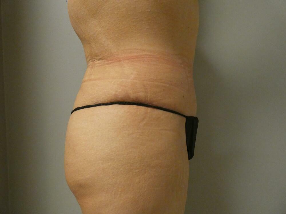 Tummy Tuck Before & After