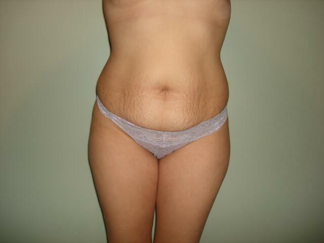 Tummy Tuck Before & After