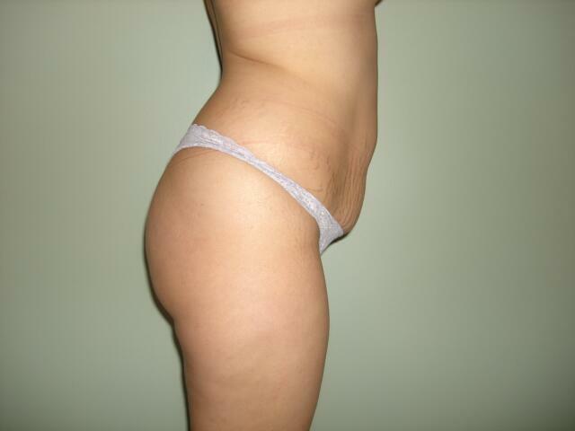 Tummy Tuck Before & After