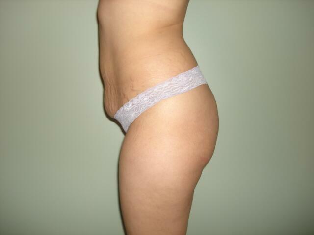 Tummy Tuck Before & After