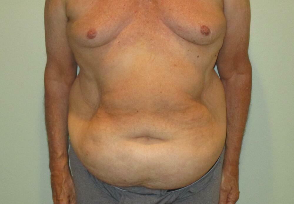 Tummy Tuck Before & After