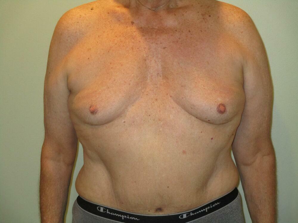 Tummy Tuck Before & After