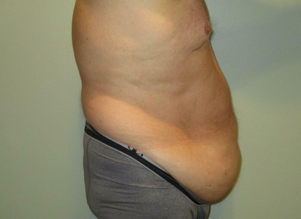 Tummy Tuck Before & After