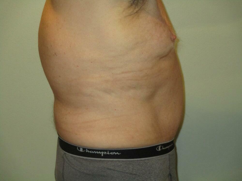 Tummy Tuck Before & After