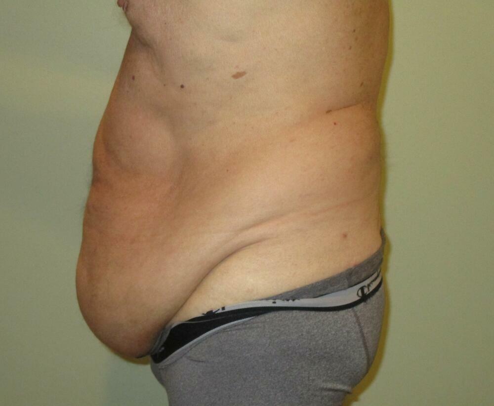 Tummy Tuck Before & After