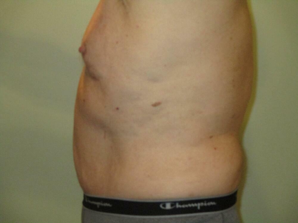 Tummy Tuck Before & After