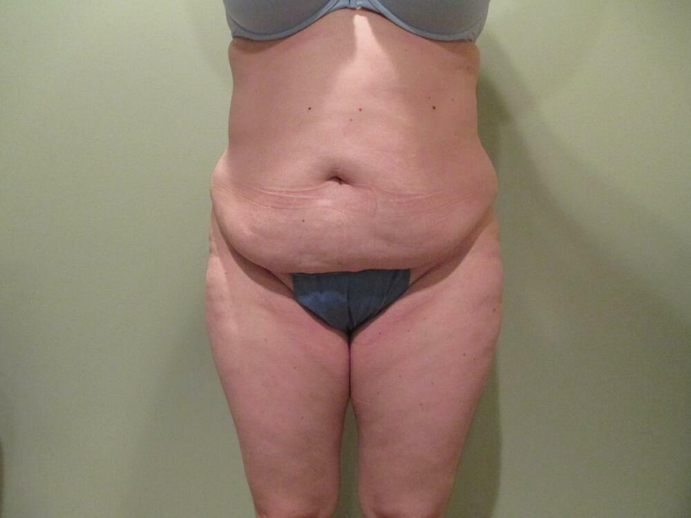 Tummy Tuck Before & After