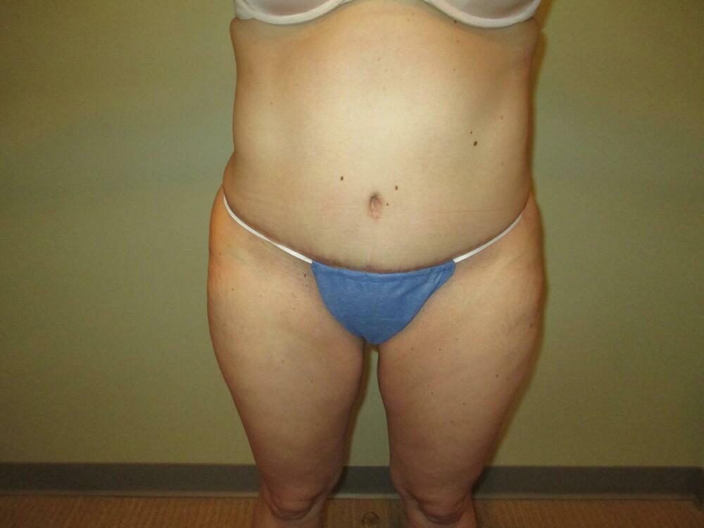 Tummy Tuck Before & After