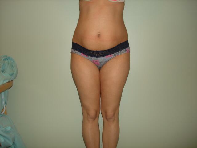 Tummy Tuck Before & After