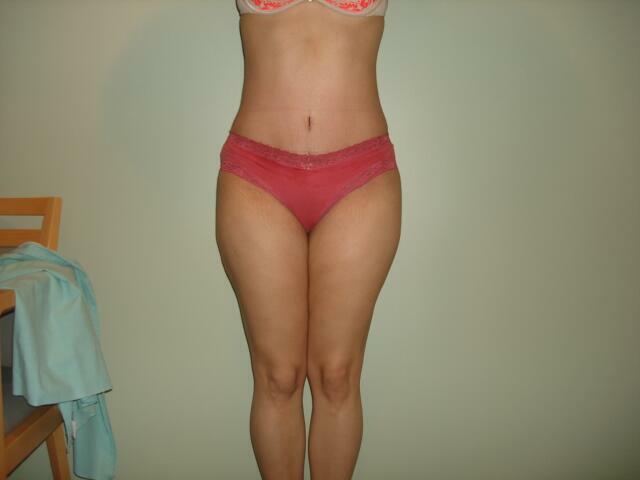 Tummy Tuck Before & After