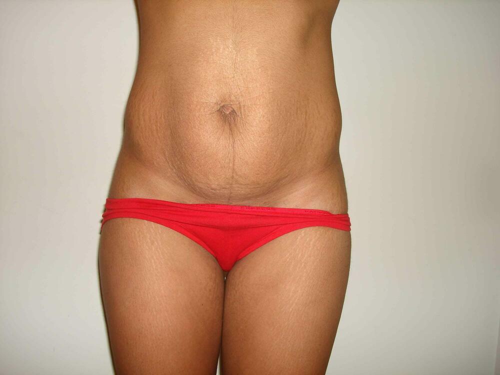 Tummy Tuck Before & After