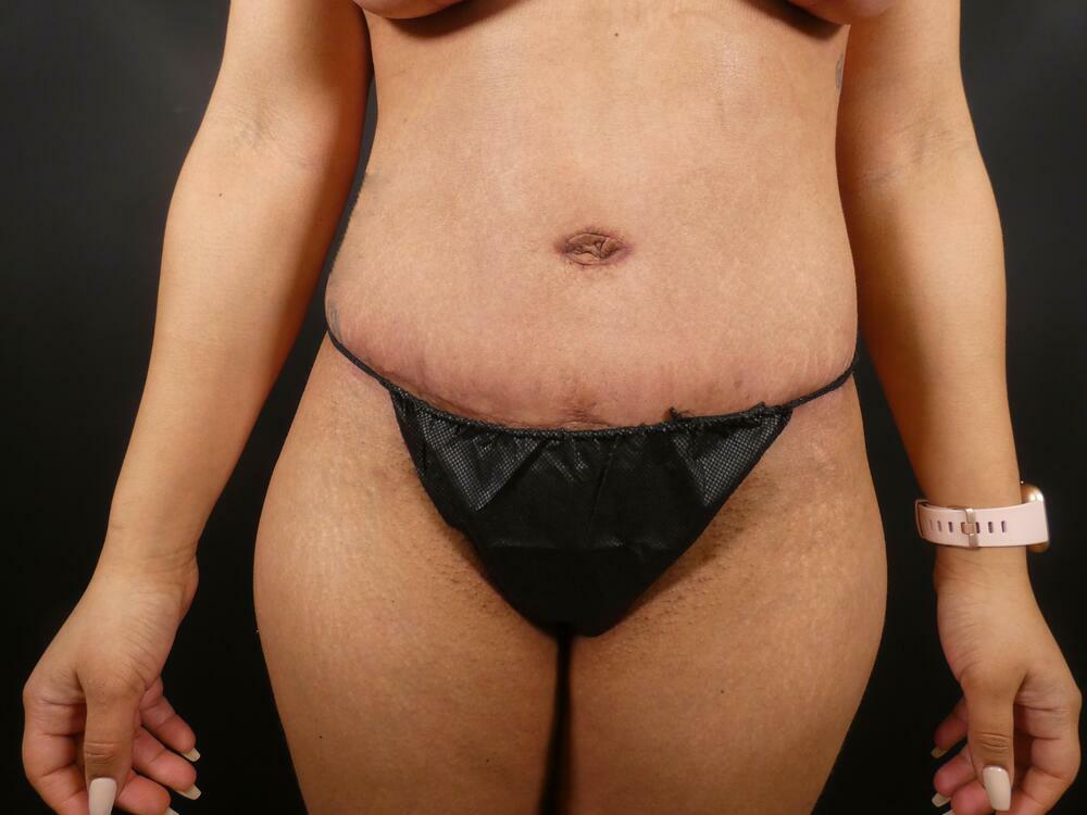 Tummy Tuck Before & After