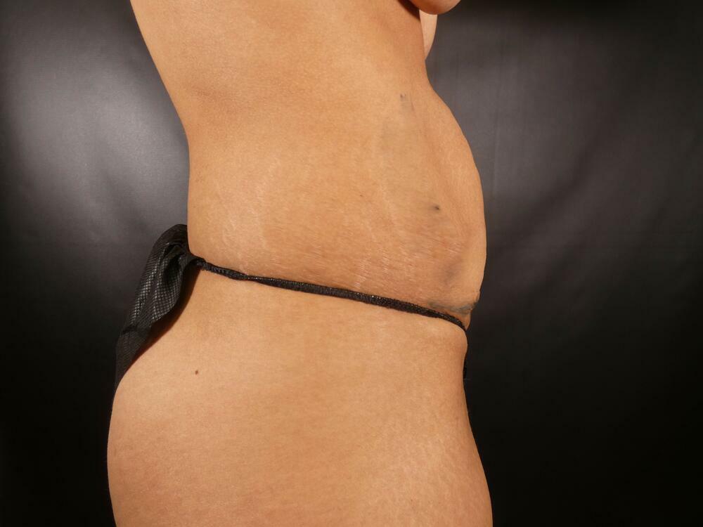 Tummy Tuck Before & After