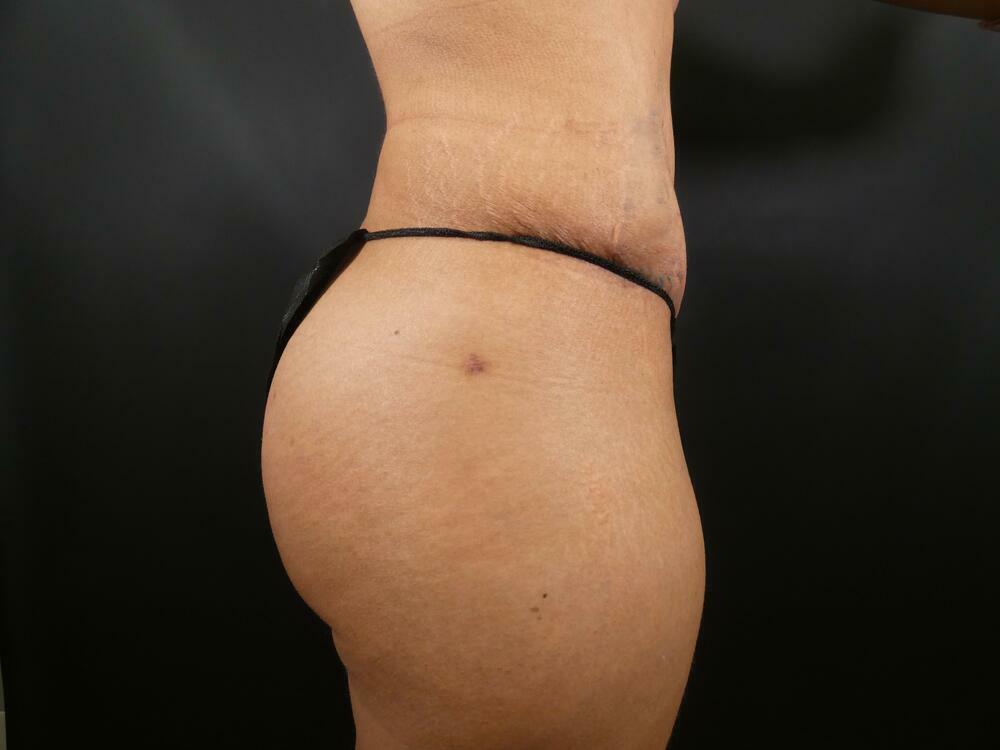 Tummy Tuck Before & After