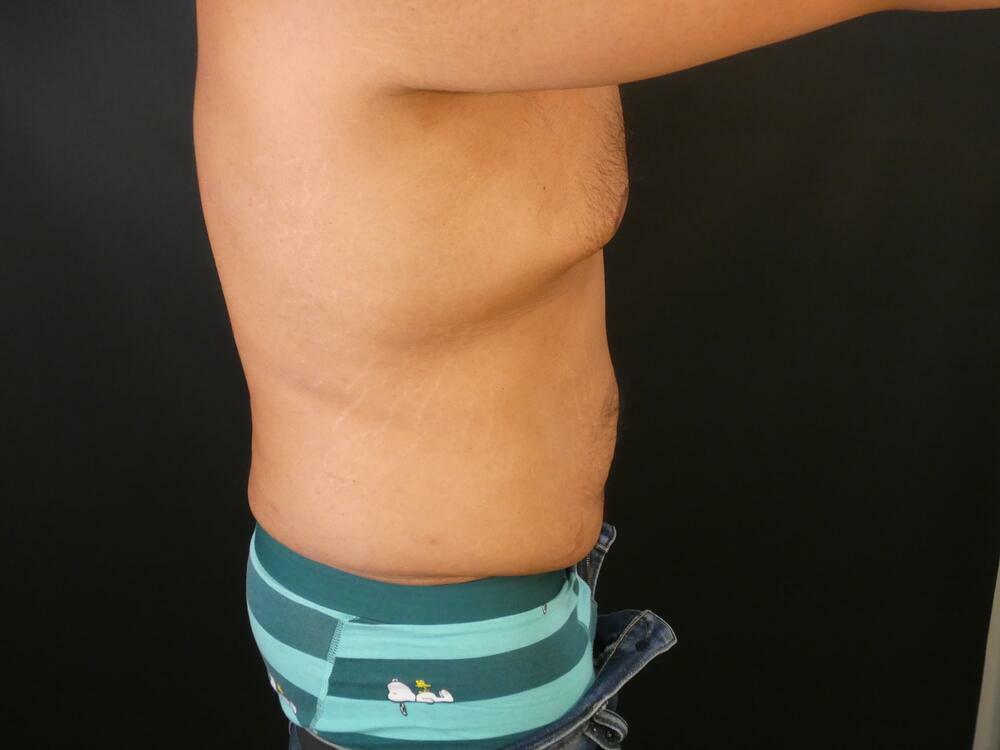 Tummy Tuck Before & After