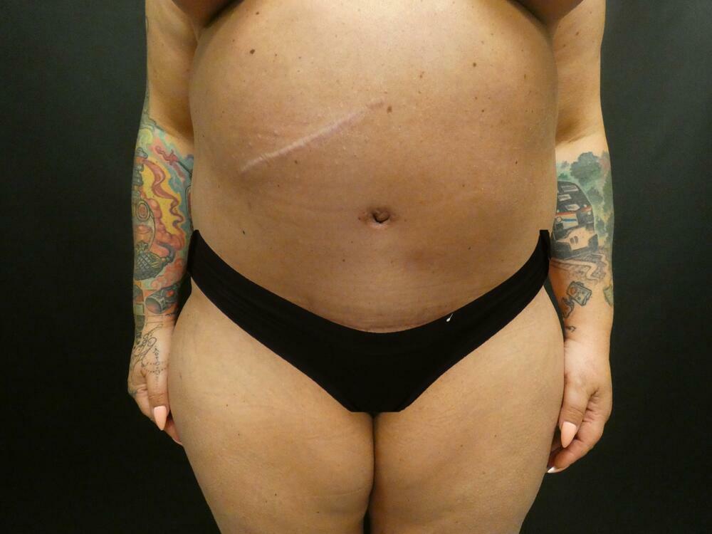 Tummy Tuck Before & After