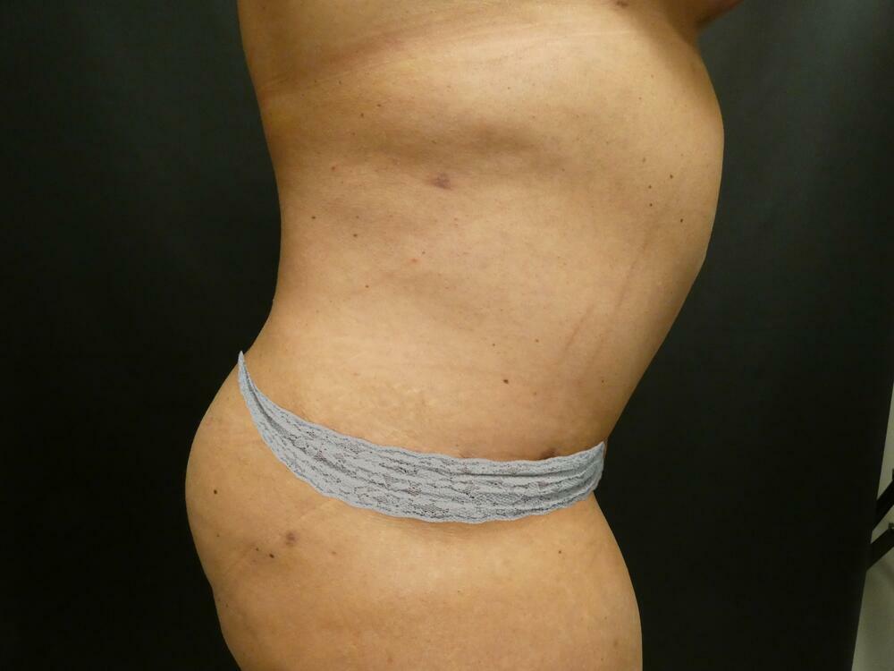 Tummy Tuck Before & After