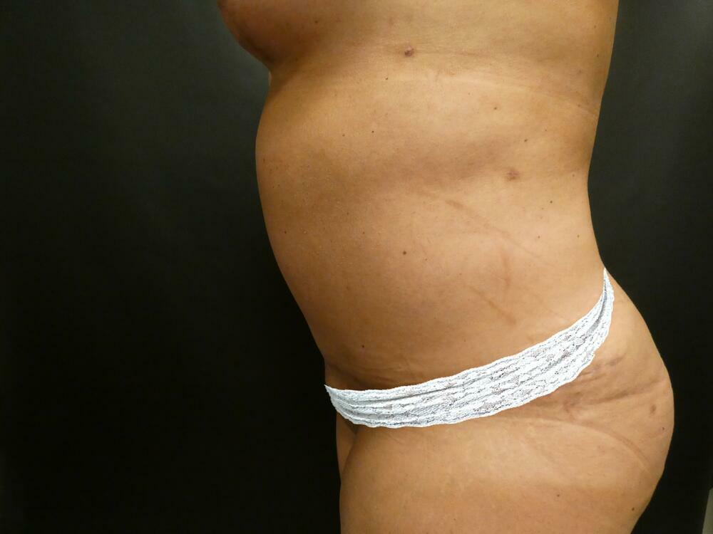 Tummy Tuck Before & After