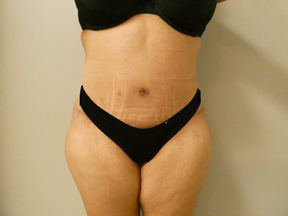 Tummy Tuck Before & After