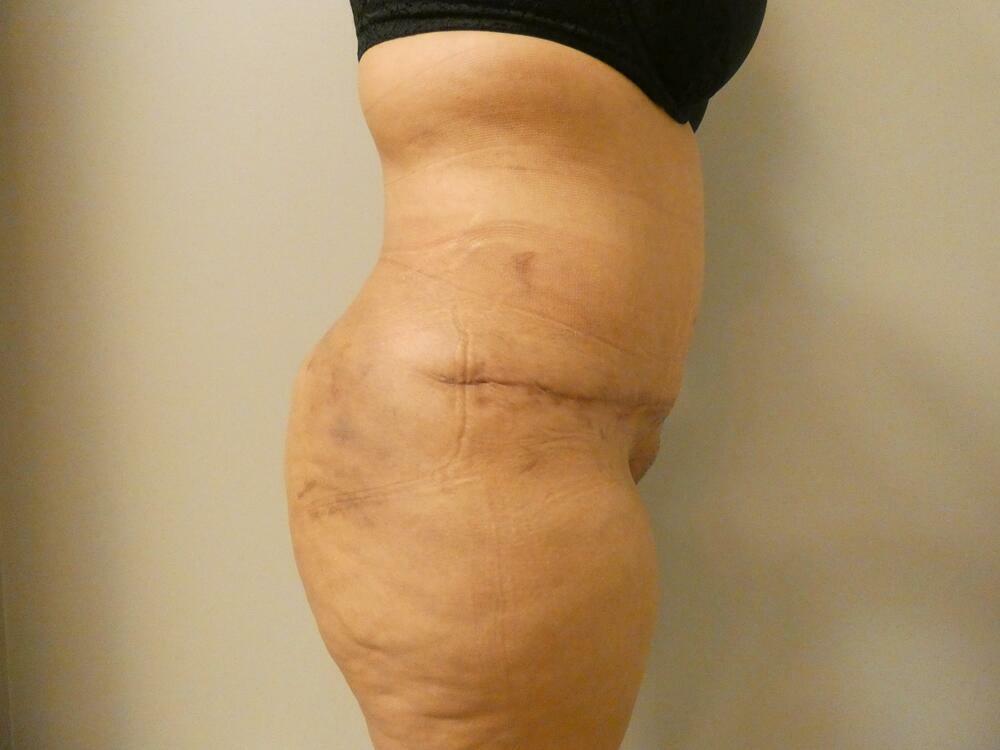 Tummy Tuck Before & After