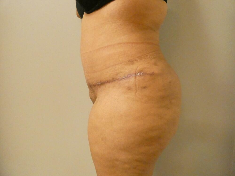 Tummy Tuck Before & After