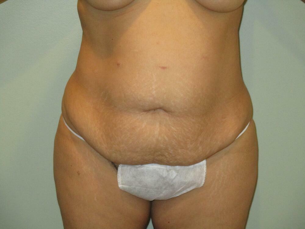 Tummy Tuck Before & After